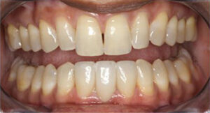 dentalimplant_after_1