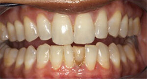 dentalimplant_before_1