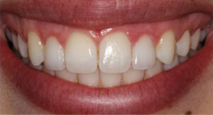 gumliftveneers_after_1