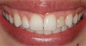 gumliftveneers_before_1