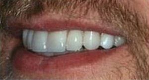 veneers_after_1