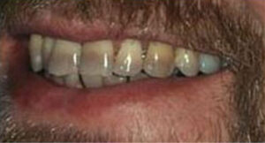 veneers_before_1